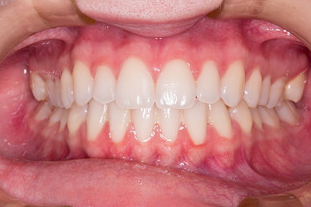 macro shot of person showing teeth