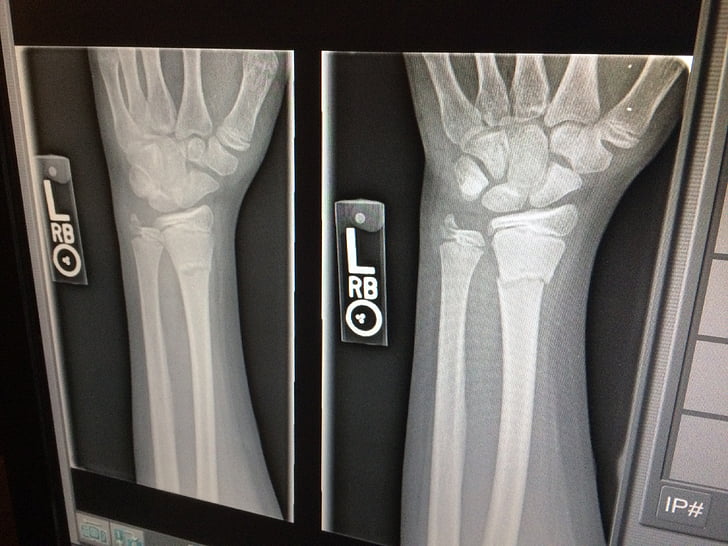 x-ray, medical, broken, arm, doctor, x ray