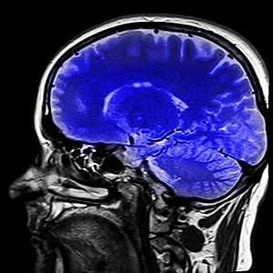 CT scan of human brain