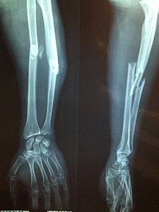 x-ray result